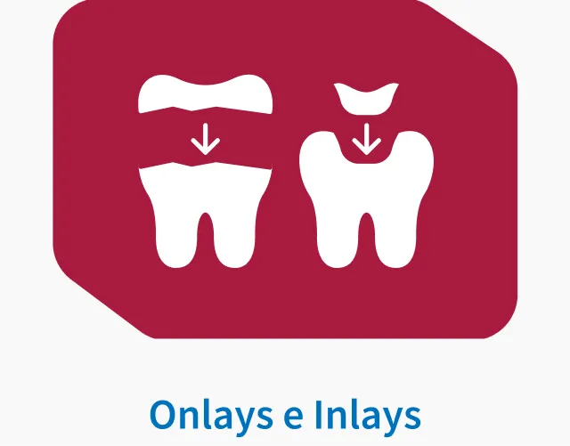 Onlays e Inlays