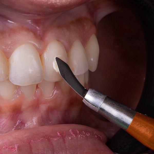 Demonstração de uso da Espátula de Resina Flexível da Indusbello