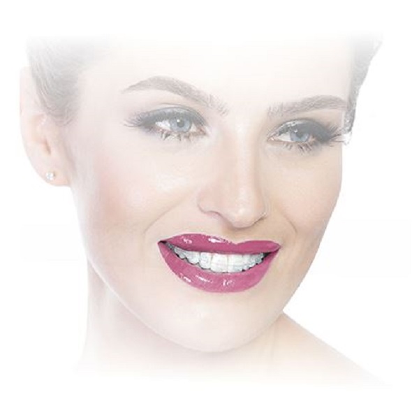  Demonstração de uso do Kit Bráquete Cerâmico PolySafira Roth 022 da Morelli  