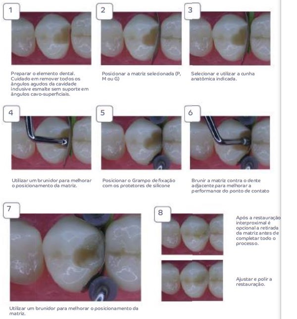 Grampo Matriz Universal Maquira | Dental Cremer - Henry Schein