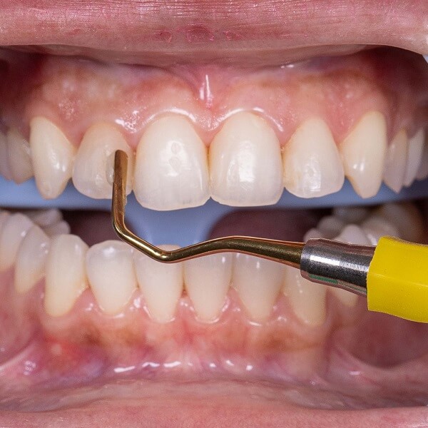 Detalhes de uso da Espátula de Resina Titânio da Indusbello