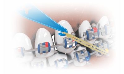 Aplicação Prática Posicionador de Elásticos Morelli