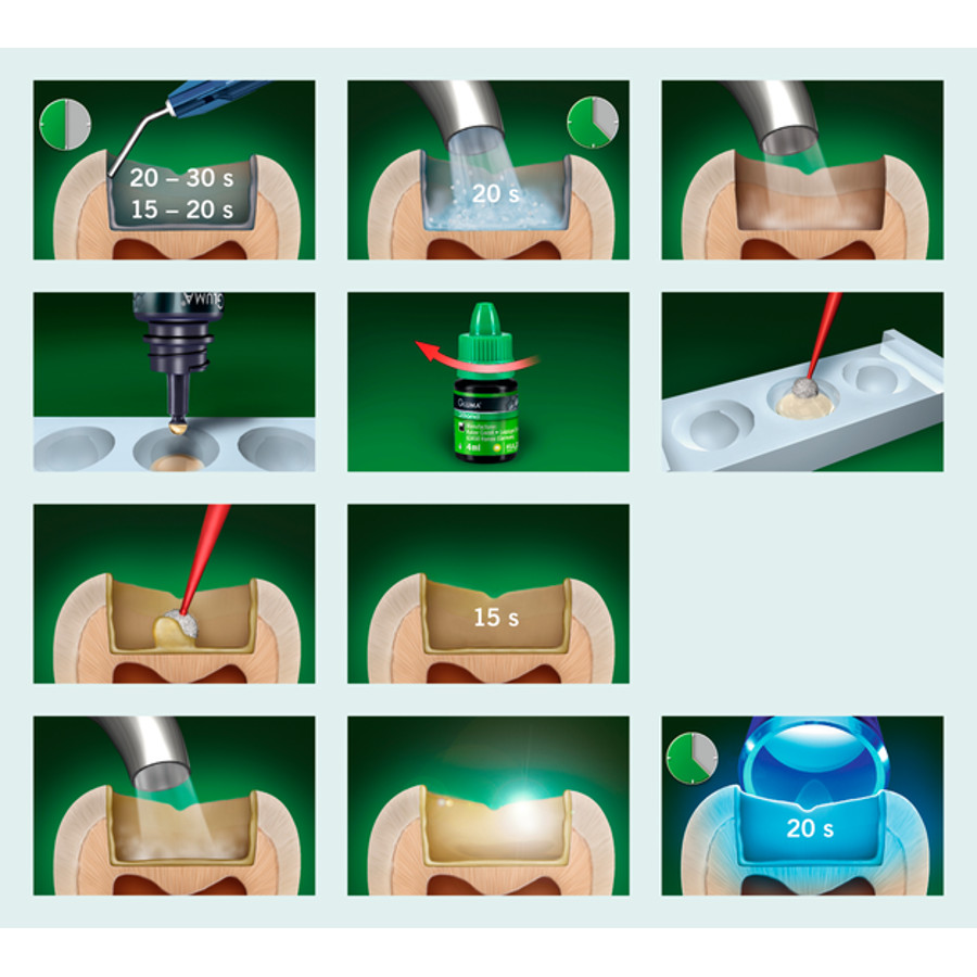 Dessensibilizante Gluma Desensitizer Kulzer Dental Cremer